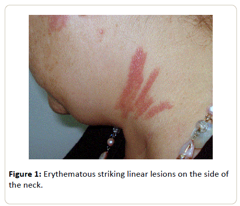 skin-diseases-and-skin-care-Erythematous-striking