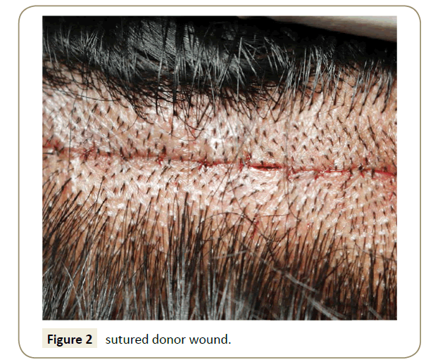 skin-diseases-and-skin-care-sutured-donor