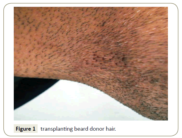 skin-diseases-and-skin-care-transplanting-beard