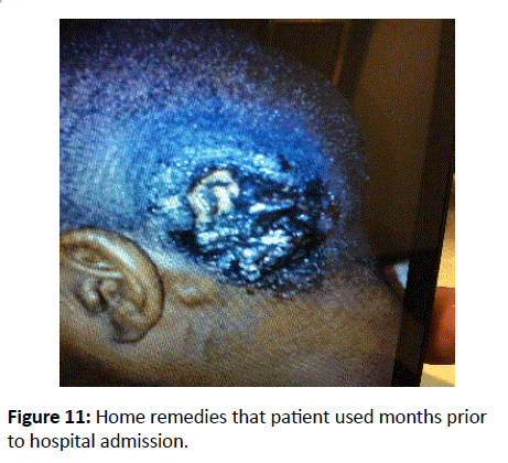 Temporal Parietal Scalp Squamous Cell Carcinoma A Case Report And Review Of Literature Insight Medical Publishing