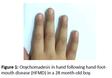 skin-diseases-skin-care-Onychomadesis-hand