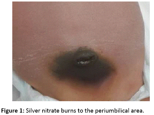skin-diseases-skin-care-Silver-nitrate-burns
