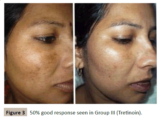 skin-diseases-skin-care-Tretinoin