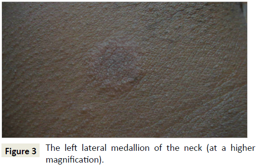 skin-diseases-skin-care-lateral-medallion-neck