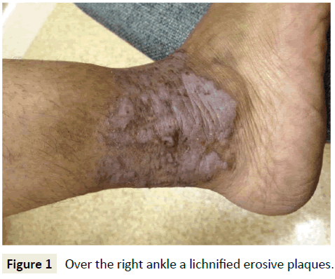 skin-diseases-skin-care-lichnified-erosive-plaques
