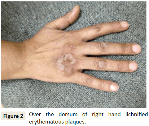 skin-diseases-skin-care-right-hand-lichnified